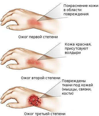 Гнойные раны – симптомы, причины, диагностика и лечение заболевания у  взрослых в клинике «Будь Здоров»