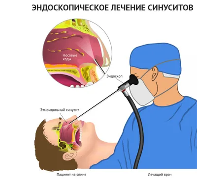 Лечение гайморита в Красноярске у детей и взрослых– Лор Нэт