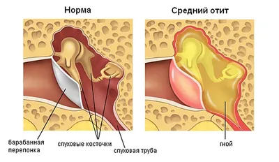 Причины хронического гнойного среднего отита