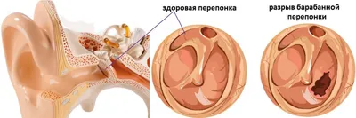 Отит у ребенка. Что делать? | Доктор Юлия | Дзен