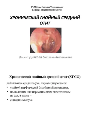 Опасность острого среднего отита