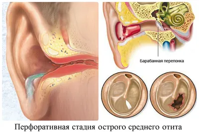 Хронический гнойный средний отит - признаки, причины, симптомы, лечение и  профилактика - iDoctor.kz