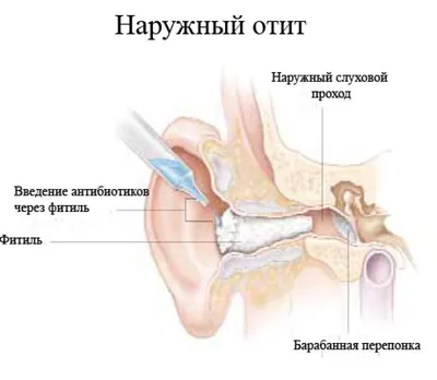 Средний Отит Вызванный Бактериями Staphylococcus Aureus Воспалительным  Заболеванием Среднего Уха стоковое фото ©katerynakon 416700938