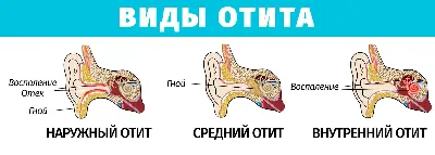 Острый отит у детей: лечение, симптомы, профилактика - советы ЛОР