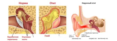 Лечение отита. Как сохранить здоровье ушей