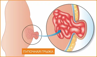 Доктор Комаровский - Уход за пупочной ранкой не предусматривает  использования каких-либо лекарств. ⠀ Правильный уход за пупком  подразумевает применение детского мыла, воды и ватных дисков один, максимум  два раза в день. Смочите