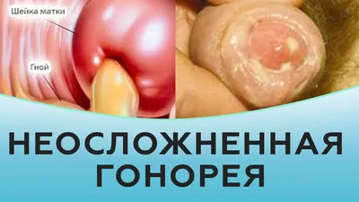 Гонорея глаз. Причины и лечение