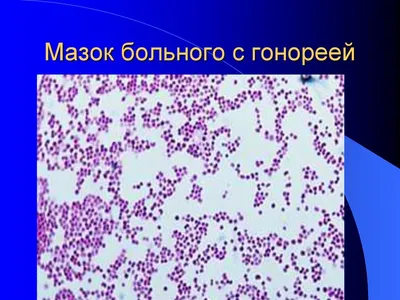 Бактерии Neisseria Гонореи Гонорея — стоковые фотографии и другие картинки  Diplococcus - Diplococcus, Бактерия, Без людей - iStock