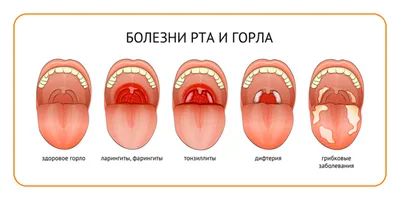 Почему болит горло с одной стороны | Новости Аркада-Мед