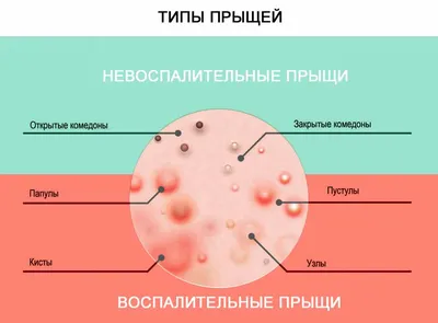 Прыщи на теле: причины, лечение, удаление, виды прыщей на лице