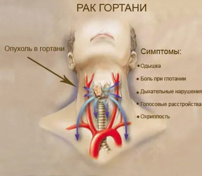 Ларинготрахеит у детей: причины, симптомы и лечение