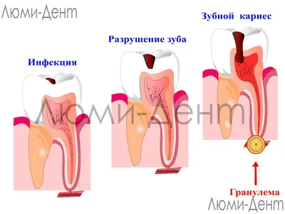 Гранулема 1 Зуба 9 Фото Лечение Киев Гнойная Корня ЛюмиДент