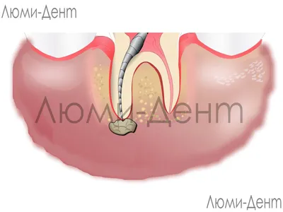 Гранулема 1 Зуба 9 Фото Лечение Киев Гнойная Корня ЛюмиДент