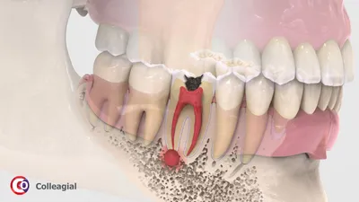 Лечение гранулемы корня зуба, цена в Москве в стоматологии Smile-at-Once