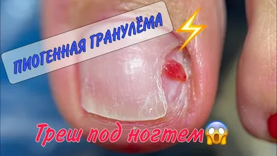 Пиогенная гранулема конъюнктивы / Интересный случай / Medicine Live