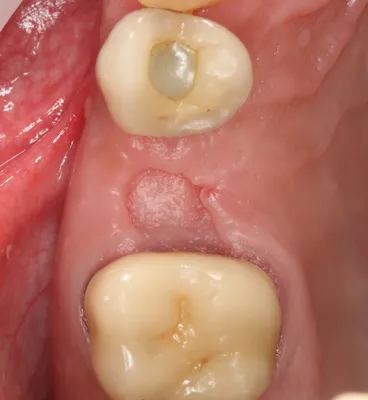 Mucograft Seal и консервация лунок удаленных зубов. Только дураки не меняют  своего мнения © — IMPLANT-IN.COM — дентальная имплантация. естественно.