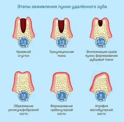 Гигиена полости рта после удаления зуба – статьи Ирригатор Бай