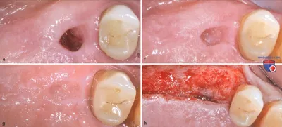 Восстановительный период после удаления зуба
