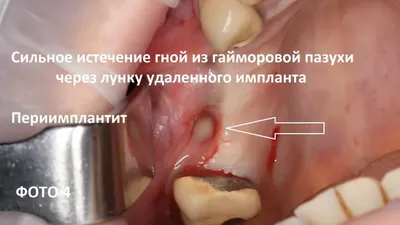 Операция Удаления Зуба-Местные Осложнения После Удаления Зуба