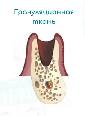 Удаление зубов - «🦷Удалила уже 4 коренных зуба, еще один - на очереди! Мой  опыт удаления в частной клинике за деньги и в государственной поликлинике  по полису ОМС! Куда же я пойду