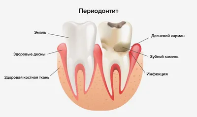 Гной В Лунке После Удаления Зуба Мудрости ЛюмиДент