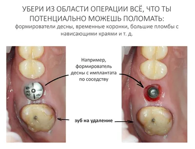 Сроки заживления лунки зуба после удаления | ВКонтакте