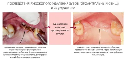 Периодонтит и пародонтит у детей - стоимость услуги Детская стоматология в  Киеве, Периодонтит и пародонтит у детей - цена в стоматологии  lipinskii.com.ua