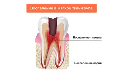 Альвеолит лунки: причины, симптомы, лечение