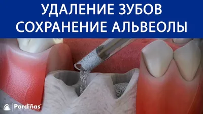 Простое удаление зуба за 10 шагов — CLINICIN.RU