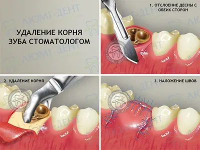 Пульпит зуба мудрости — лечить или удалять?