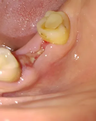 Почему не проходит отёк после удаления зуба? (Москва) - Профессиональный  стоматологический портал (сайт) «Клуб стоматологов»