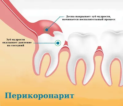 Заболевания пародонта - статья