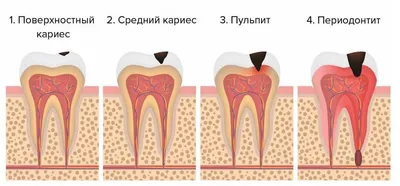 Лечение альвеолита лунки после удаления зуба в Москве - клиника Медведева