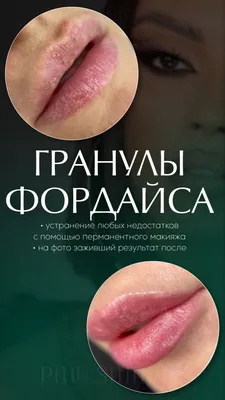 Дерматолог Самойленко - 👄 Гранулы Фордайса: вариант нормы или патология ?  👄 💋 Гранулы Фордайса – образования, которые чаще всего можно обнаружить  на губах, вокруг рта, в области подмышечных впадин и половых