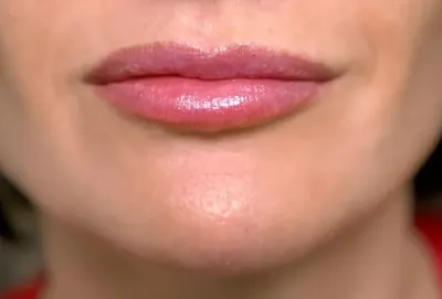 Master_lips_face - Гранулы Фордайса, или по-другому их называют себорейные  кисты - это сальные железы на коже. Эти гранулы похожи на мелкие (1-2 мл.)  пятнышки и папулы (маленькие узелки) белого или желтоватого цвета.