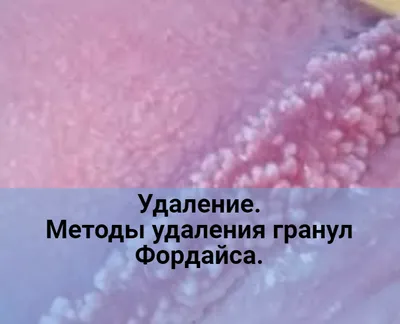 Татуаж губ - «Не ожидала такого крутого эффекта...гранулы Фордайса VS  татуаж губ! Теперь я просто обожаю свои губы! » | отзывы