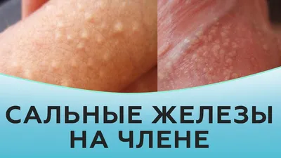 Гранулы фордайса - это... - Darya Dermeleva Permanent makeup | Facebook