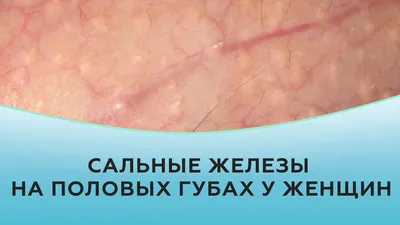 ГРАНУЛЫ ФОРДАЙСА: что это такое и надо ли их удалять. Врач-дерматовенеролог  | КЛИНИКА MEDICRIS - YouTube