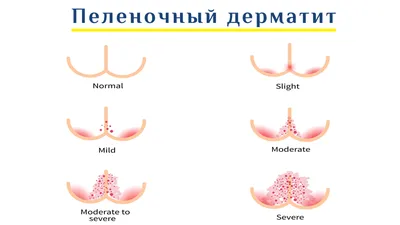 Дерматит грибкового кожного заболевания Seborrheic в голове ребенка,  конце-вверх, корке Seborrhea, дерматологии Стоковое Изображение -  изображение насчитывающей зуд, здорово: 143666319