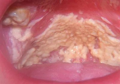 Кандидоз полости рта: симптомы, особенности, диагностика и лечение  заболевания - блог «ДИНАСТИЯ»
