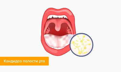 Стоматит: лечение, симптомы, виды, признаки у взрослых и детей