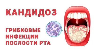 Кандидоз полости рта – дискомфорт плюс риск грозных осложнений —  ThePharma.Media