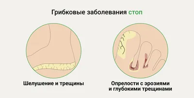 Бородавки у детей: лечение и удаление. Как вывести бородавки у ребенка.