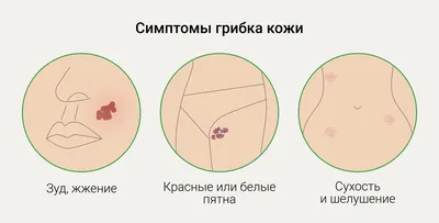 Лечение грибка кожи в Москве в отделении дерматовенерологии клиники ИАКИ