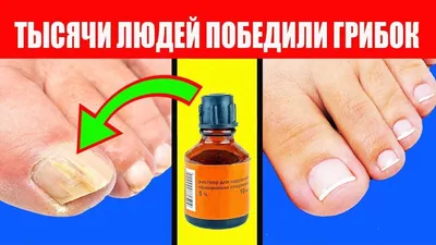 Как вылечить грибок на ногтях ног? NormaDerm от грибка ногтей  (ID#1254699557), цена: 169 ₴, купить на Prom.ua