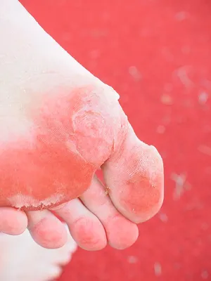 Foot Fungus Treatment | Toenail Fungus Care - Nailyuba