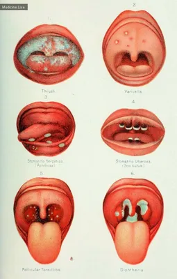 Стоматит: лекарства для взрослых и детей — симптомы и причины появления на  языке, губах и деснах, средства для лечения