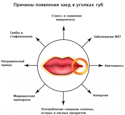 Молочница во рту – причины, симптомы и лечение | Энциклопедия ГЕКСОРАЛ®