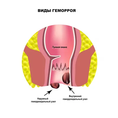 Боль при дефекации - причины появления, при каких заболеваниях возникает,  диагностика и способы лечения