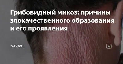 Способ дифференциальной диагностики грибовидного микоза от хронических  дерматозов. Патент № RU 2687274 МПК G01N33/483 | Биржа патентов -  Московский инновационный кластер